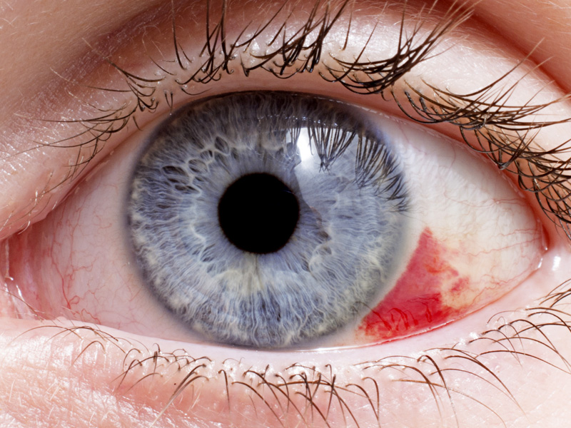 Sangre en el ojo