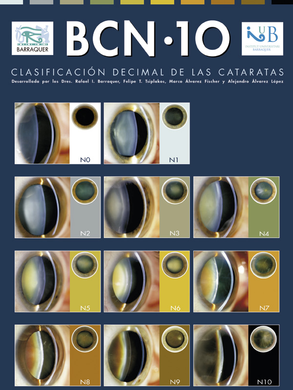 Nueva clasificación para las cataratas