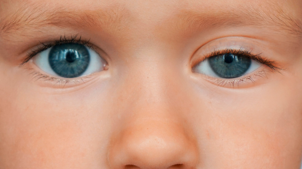 Ptosis palpebral