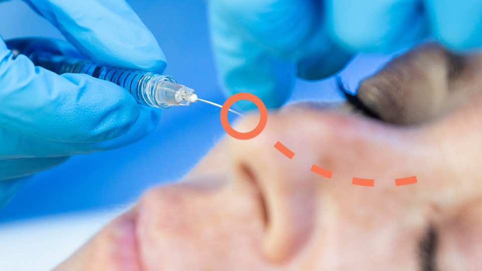 Beneficios del ácido hialurónico