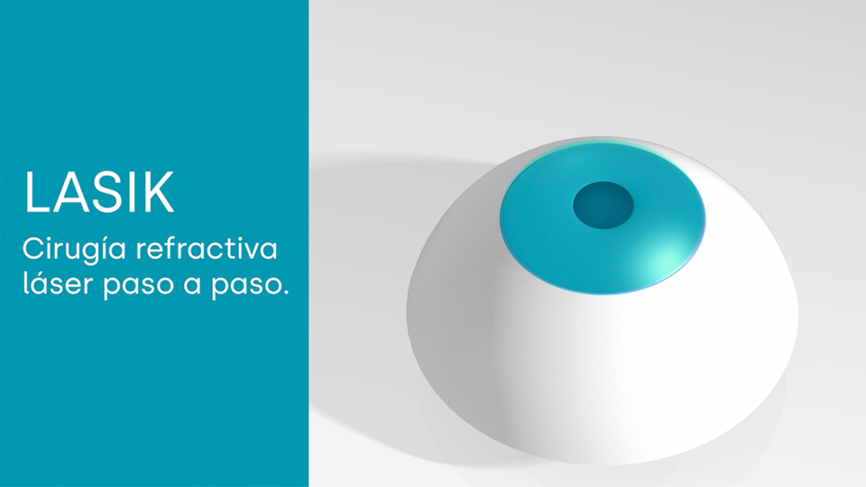 Cirugía refractiva corneal con LASIK