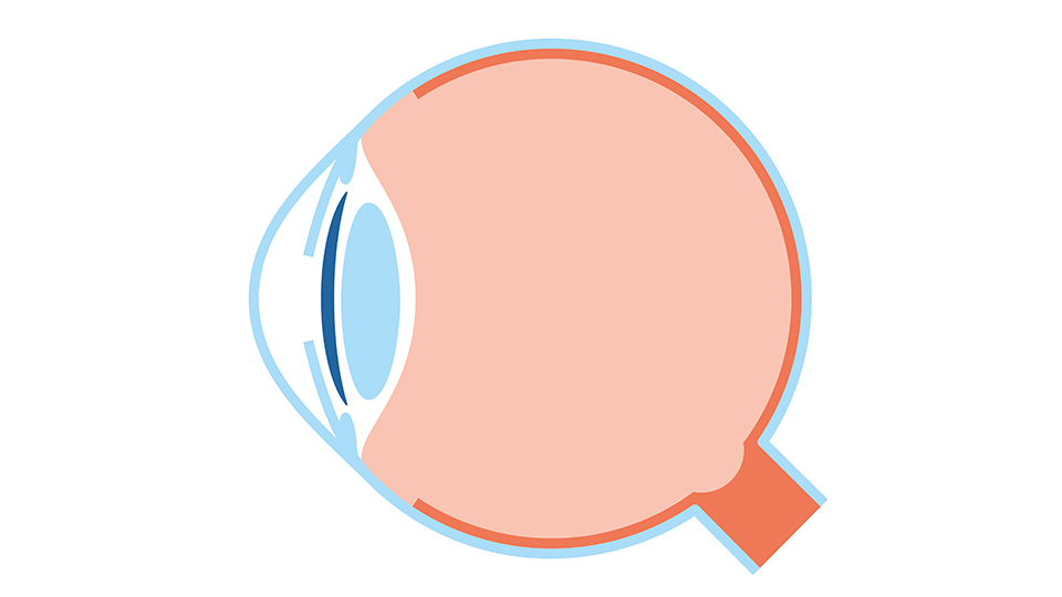 Lentes intraoculares fáquicas
